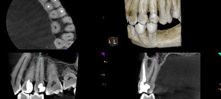 CS 8200 3D Neo Edition: 5 x 5 FOV showing unfilled root canal